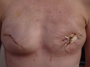 Infection Double(2)